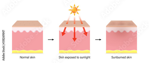 Layers of skin before, during and after sunburn. Skin without UV protection sunscreen. Vector for advertising about beauty and medical treatment.