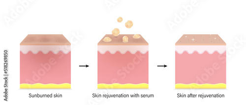 Skin layers before, during and after rejuvenation with skin serum. Skin care vitamins. Vector for advertising about beauty and medical treatment.