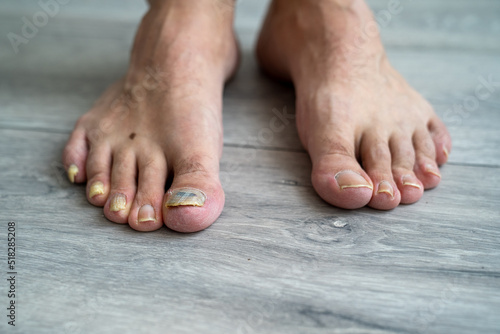 Φωτογραφία male man feet close up, nail fungus, skin and nail infection, toe mycosis, treat
