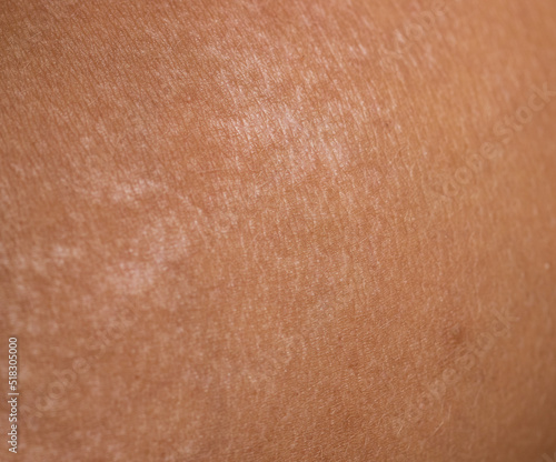 pigment spots on the skin after a sunburn