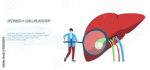 Tiny physician examines human liver with magnifier to diagnose gallstones. Medical observation flat vector banner for diagnostic center, laboratory, clinic, research institution, conference etc. 