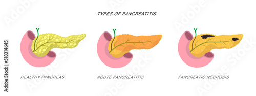 Infographics demonstrating the difference of pancreatitis and pancreatic necrosis Disease diagnostic procedure illustration.  photo
