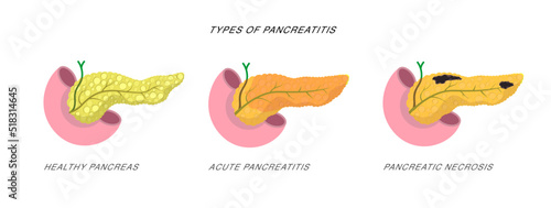 Infographics demonstrating the difference of pancreatitis and pancreatic necrosis Disease diagnostic procedure illustration. 