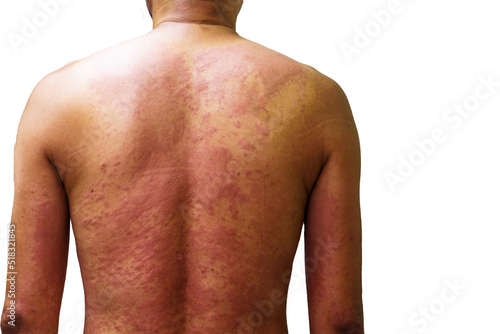 Young man with rash from the drug allergy