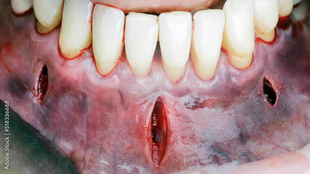 Obraz premium gum incisions during mandibular resection