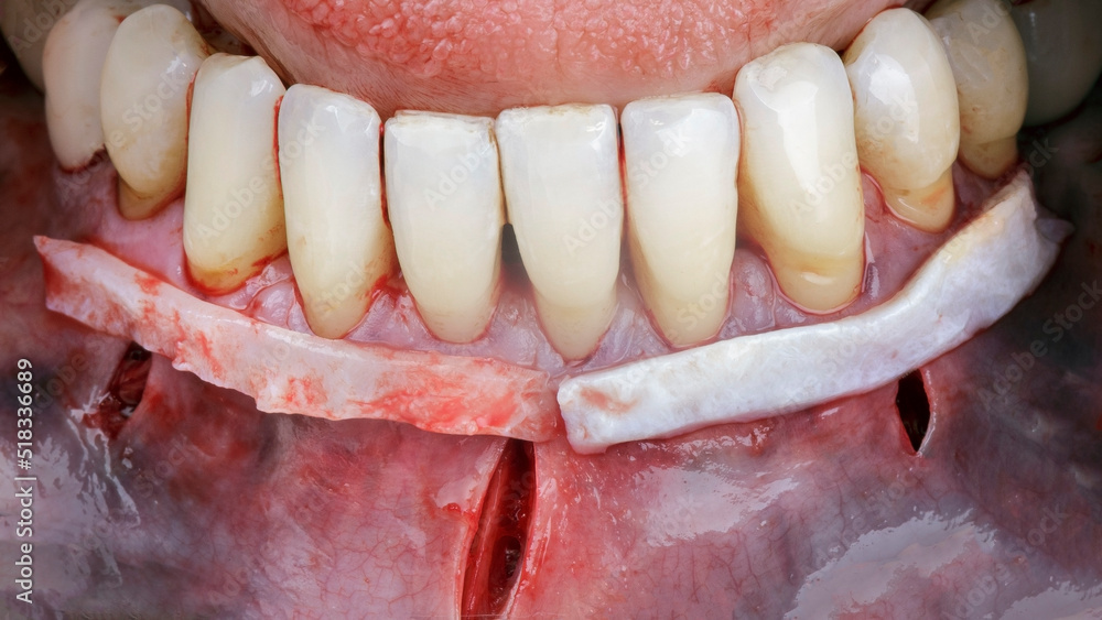 two long dental soft tissue flaps to be added to the mandibular gingival cavity
