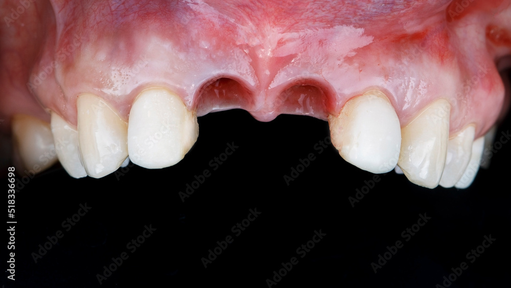 two removed central teeth and installed implants on a black background