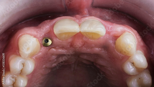 restored dental gingiva with gingiva former after implantation
