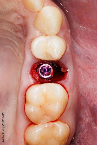 oral cavity with one installed dental implant