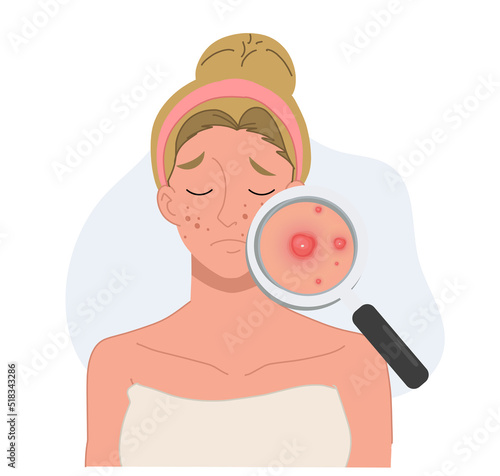 vector illustration about Acne skin problems Concept.  woman with magnifying glass is looking acne on her facial.