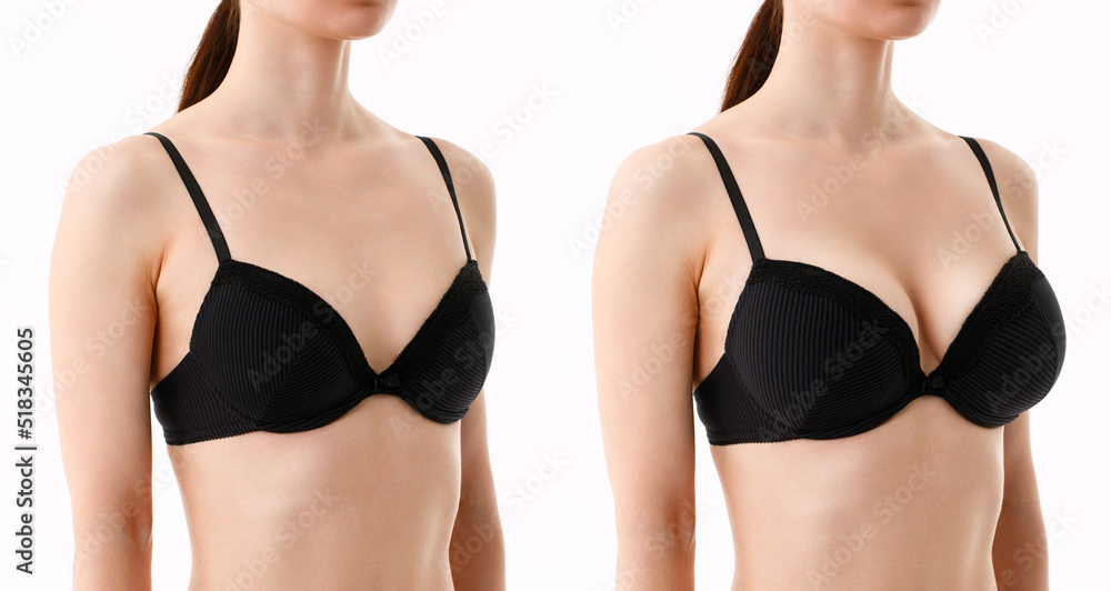 Bust of a woman before and after breast augmentation surgery