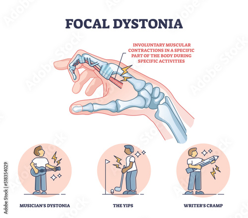 Focal dystonia as anatomical neurological muscle disorder outline diagram. Labeled educational medical explanation with involuntary muscular contractions in specific body part vector illustration.