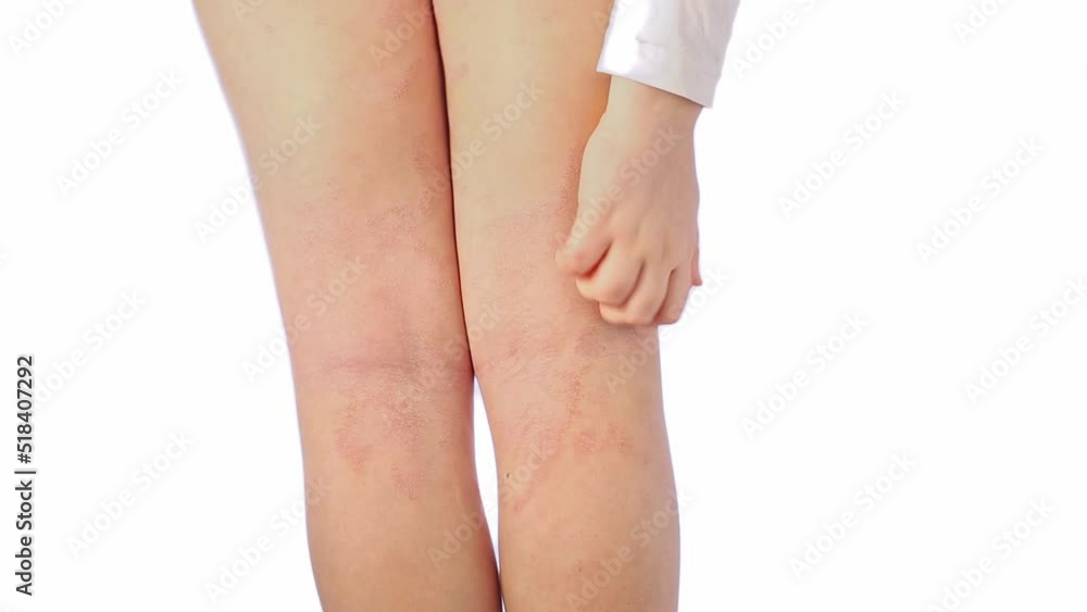 Bumpy Rash Behind Leg Acute atopic dermatitis on the legs behind the knees of a child is a ...