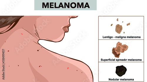 Three types of melanoma vector image