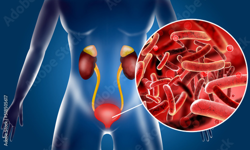 Illustration of woman suffering from cystitis. Urinary infection