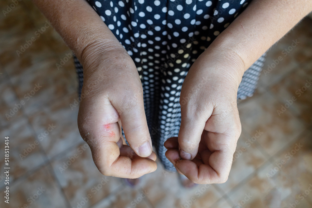 Close-up hand inflammation. Left hand was very swollen in region of the ...