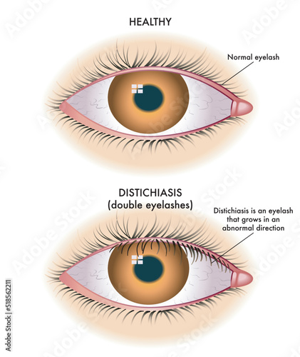 Medical illustration shows the comparison between a normal eye and one affected by distichiasis.