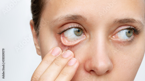 Cropped shot of a young caucasian woman showing off her pale conjunctiva isolated on a white background. Iron deficiency anemia. Reduced hemoglobin photo
