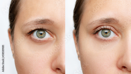 Cropped shot of a young caucasian woman's face with drooping upper eyelid before and after blepharoplasty isolated on a white background. Result of plastic surgery. Changing the shape, cut of the eyes photo
