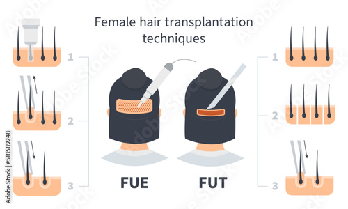 Female hair transplantation FUE and FUT comparison, stages of Follicular Unit Extraction. Treatment of baldness, alopecia and hair loss. Vector medical infographic, woman's head and nape