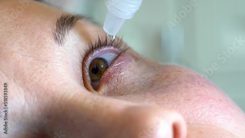 The eyes of a young woman. At the doctor. Instillation into the eyes. Treatment of eye diseases. Cosmetology. Ophthalmologist. Face with fair skin. Close-up. Macro.