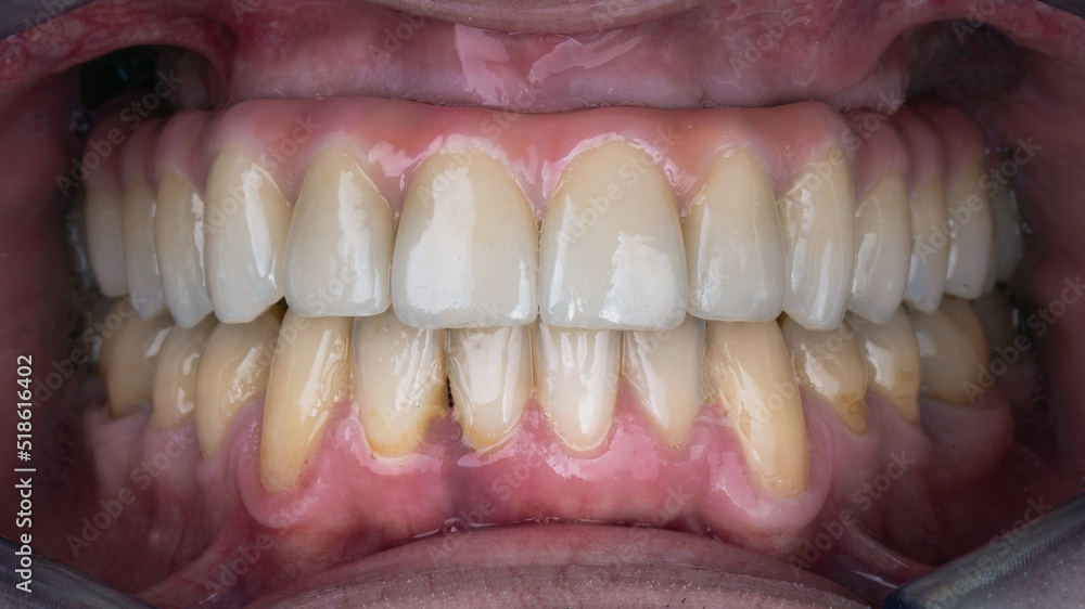 Fototapeta premium finished prosthesis made of ceramics and titanium in the cavity of the patient's upper jaw