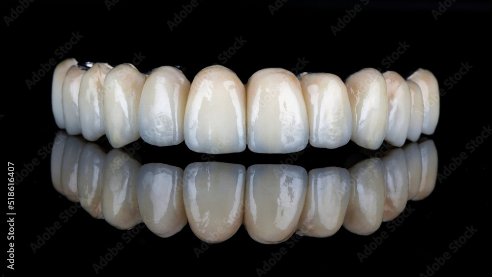 ceramic prosthesis without gums with a titanium bar for the upper jaw on black glass with reflection ceramic prosthesis without gums with a titanium bar for the upper jaw on black glass with reflection