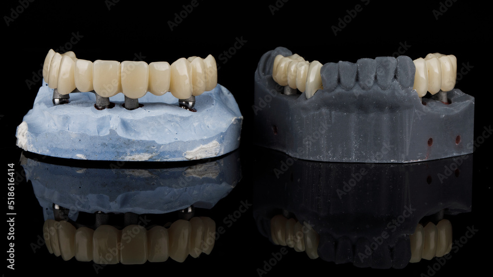 two dental models with temporary dentures on black glass with reflection two dental models with temporary dentures on black glass with reflection