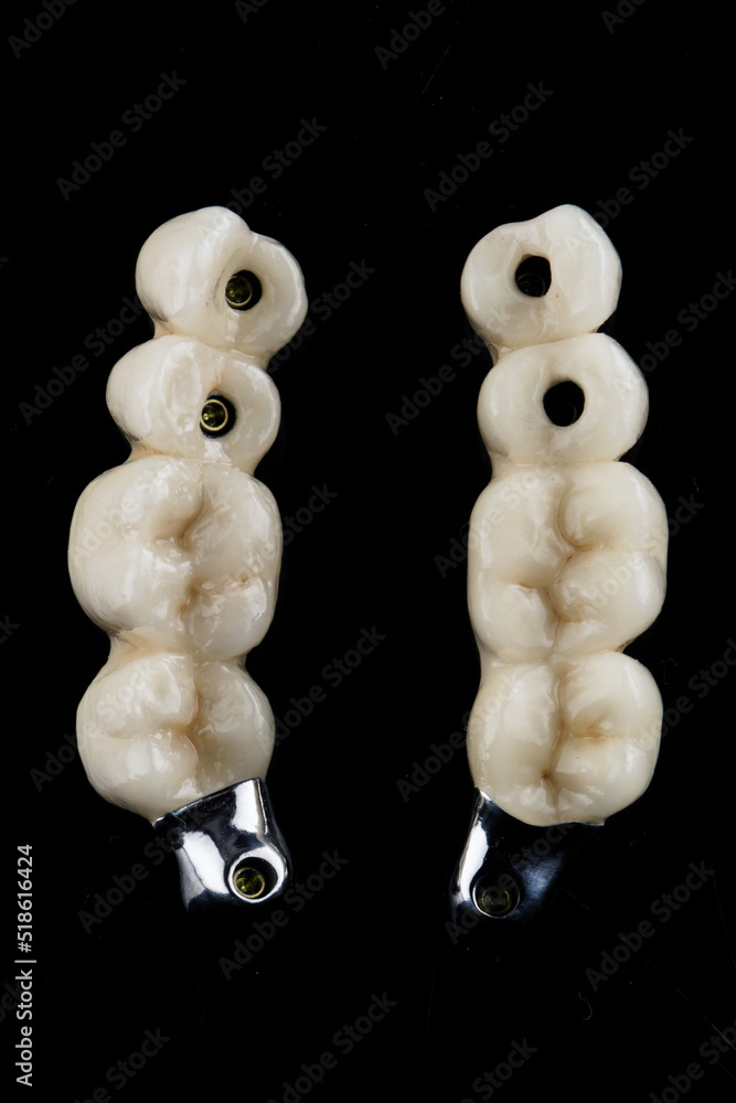 Obraz premium two prosthesis bridges made of zircon and titanium bar, top view on a black background