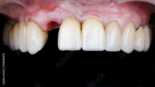 absence of a central tooth after implantation and installation of a crown