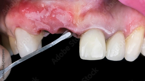 thin dental tool for working with soft tissues before implantation