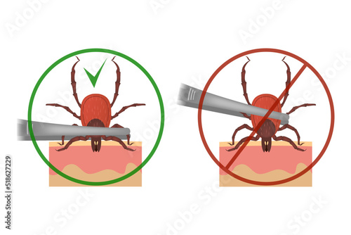 Infographic with correct and incorrect tick removal using tweezers. Medical poster. Vector illustration