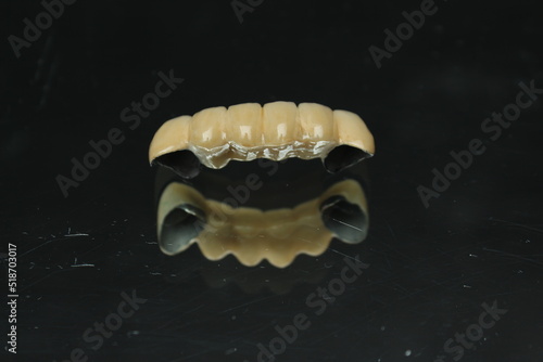 Dental PFM crown and bridge with all porcelain baked