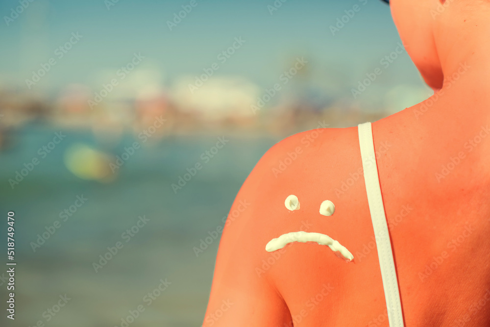 Fototapeta premium Woman with sun protection cream in the shape of sad smile on her burned shoulder. Summer, healthcare and vacation concept