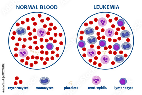 Leukemia. blood cancer. bodies under the microscope. Medical poster. Vector illustration