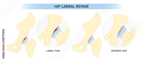 Surgery for hip bone Pain and range of motion groin head tear Treat joint thigh femur injury spurs socket lesion