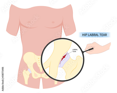 Fracture of hip bone Pain and range of motion groin head tear Treat joint thigh femur injury spurs socket lesion