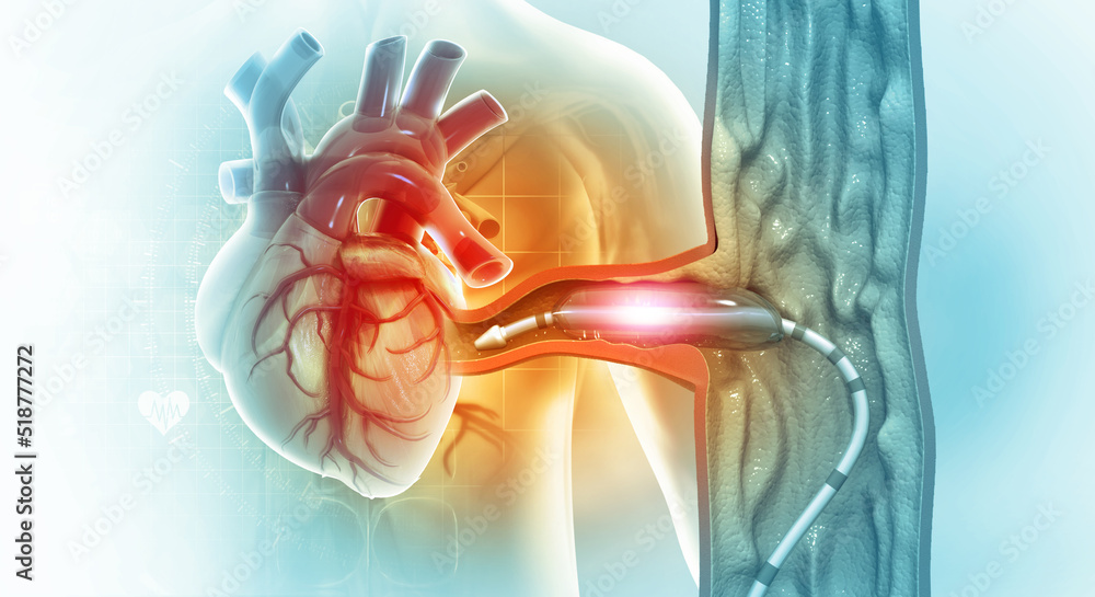 Cardiac catheterization procedure. Stent angioplasty. 3d illustration