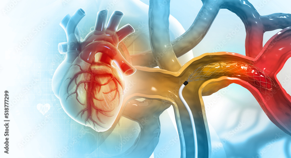 Cardiac catheterization procedure. Stent angioplasty. 3d illustration