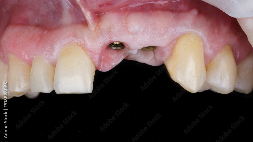 two installed dental implants in the upper jaw before prosthetics