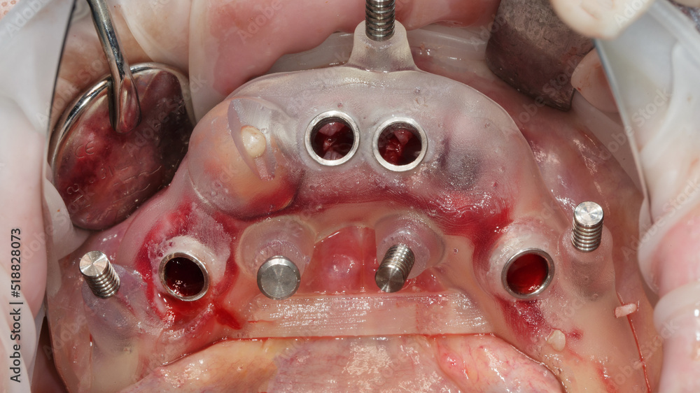 Fototapeta premium surgical dental template in the oral cavity before total implantation