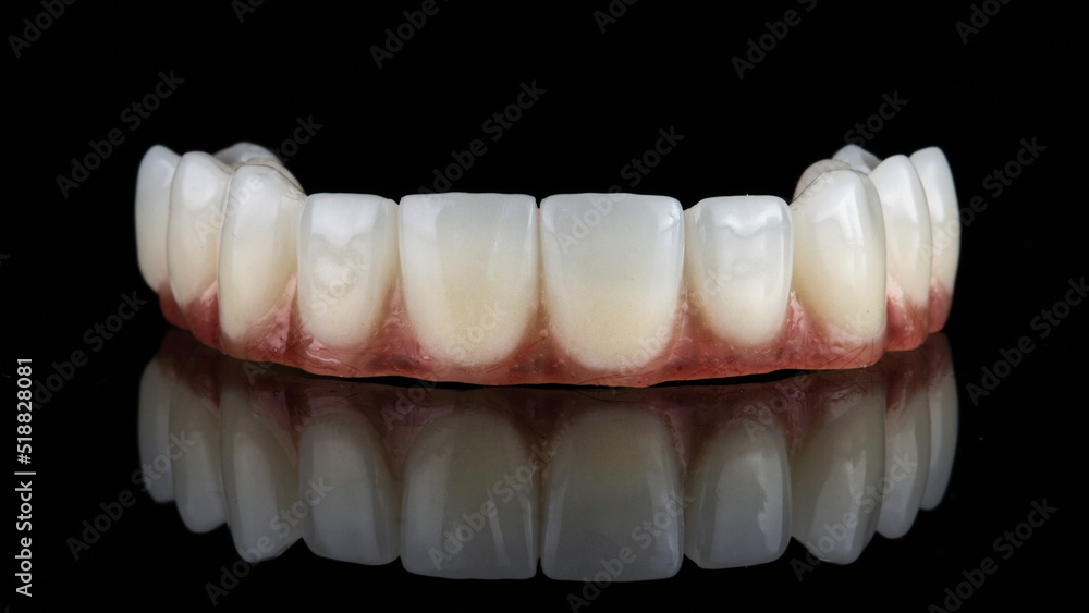 temporary dental prosthesis of the upper jaw made of plastic on a black background temporary dental prosthesis of the upper jaw made of plastic on a black background