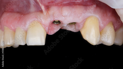 two installed dental implants in the upper jaw before prosthetics