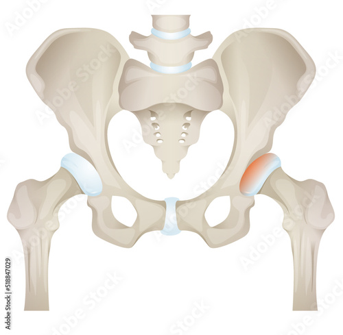 Osteoarthritis - Bone Death - Hip Joint - Stock Illustration