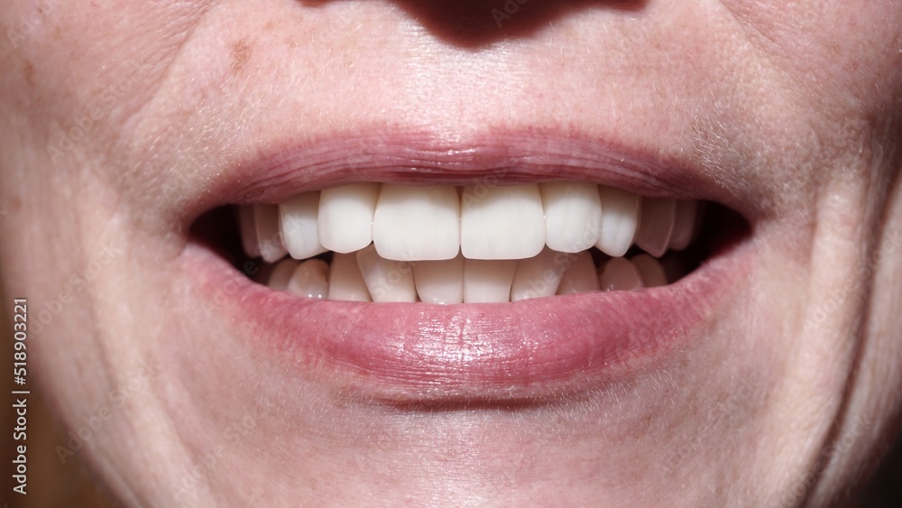 Obraz premium Teeth after caries treatment. Woman with veneers smiling at camera