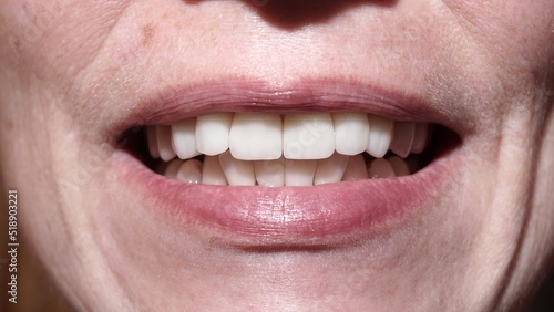 Teeth after caries treatment. Woman with veneers smiling at camera