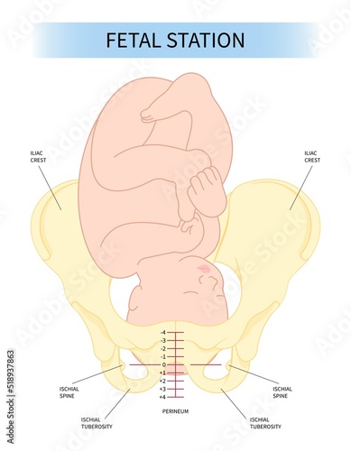 twins Baby birth cervix of Right spine Labor C section praevia Mother cord hip lie bone fetal born Head Down canal Left womb pelvis score Breech defect vertex Exam uterus Frank Bishop weeks Infant photo