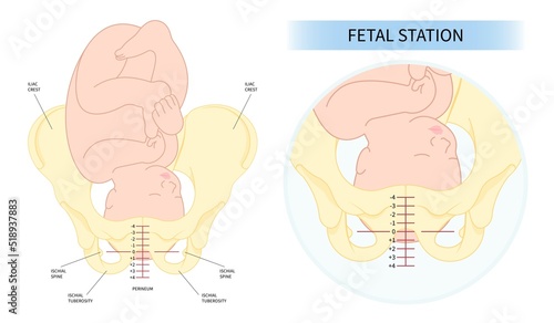 Print op canvas Labor and C section fetal Baby born Head Down by praevia Mother twins cord hip l