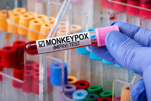 Researcher holding blood test tube infected with monkey pox Monkeypox virus (MPXV). Doctor with a blood test in a tube diagnosed positive with zoonotic virus MPXV Monkeypox disease. photo