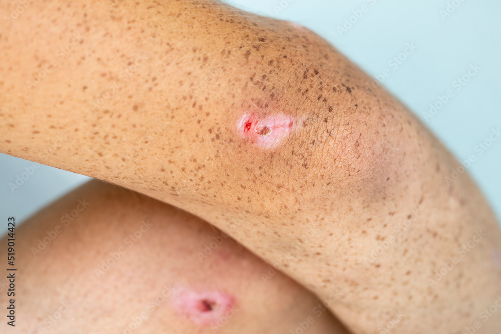 A small wound on the elbows and knees of a teenager A small wound on the elbows and knees of a teenager